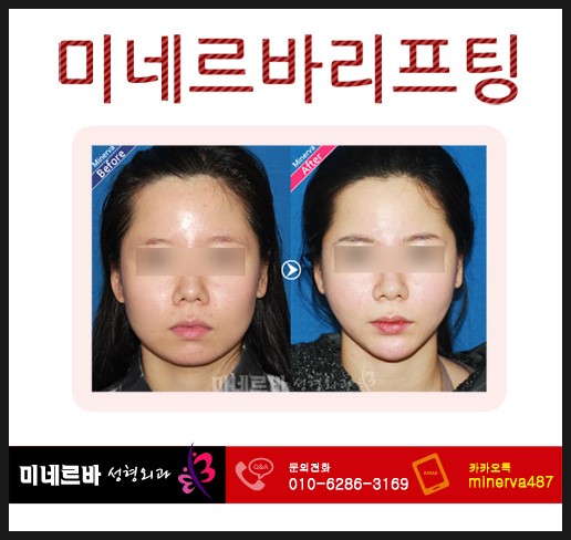 V라인리프팅 이벤트 V라인리프팅+더블로리프팅/V라인리프팅+필러 : 네이버 블로그