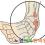 공릉동한의원-발목염좌는 한의원에서