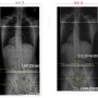 디스크 시술후 재활 김OO 50세 재활치료 전후사진 [고양시,일산,행신,도수교정치료,수술후재활운동치료]