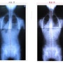 이OO 여 12세 척추측만증 교정치료 전후 사진 [일산,고양시,행신 도수교정센터, 자인메디병원]