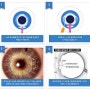 초고도근시 교정수술 알티산 렌즈 [명동푸른안과]