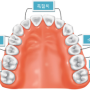 [일산소아치과] 실란트란?