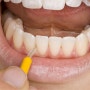 [치아건강] 20~30대 급성 치주염에 시달리는 이유는?