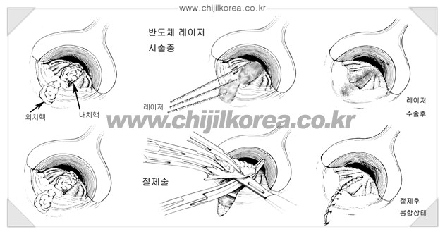 [정다운외과 치핵 클리닉] - [치핵 치료법] - [반도체 레이저 치핵치료법] : 네이버 블로그