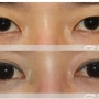 What is double eyelid surgery?--Understanding Asian double eyelid(1)