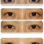 Magic epicanthoplasty as a new paradigm in double eyelid surgery
