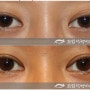 Suggestions for various eyelids--Understanding Asian double eyelid surgery(2)