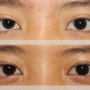 Revisional double eyelid surgery