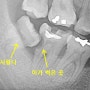 사랑니 꼭 빼야만 할까요? [울산 사랑니/울산 치과/울산 신정동 치과]