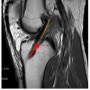 십자인대 재건술, cruciate ligament reconstruction [일산, 행신, 고양시, 무릎, 발목, 스포츠재활 전문]