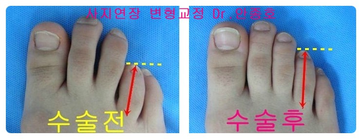 단지증 수술방법(내고정, 외고정)에따른 장단점 : 네이버 블로그