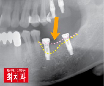 임플란트 뼈이식 기간과 일반 임플란트 기간 : 네이버 블로그