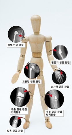 [스마트인 보험청구] 사지골, 사지관절 관절수술의 1~5종 구분 : 네이버 블로그