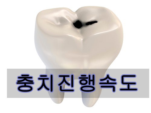 충치진행속도, 충치 진행단계에 대해 알아볼께요! : 네이버 블로그