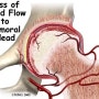 [구미 재활운동]Avascular necrosis of Femoral head