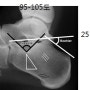 [구미 재활운동]Calcaneus Fx.