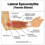 [구미 재활운동] 테니스 엘보우(lateral epicondylitis)