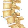 [구미 척추 재활운동] 척추전방전위증(spondylolisthesis)