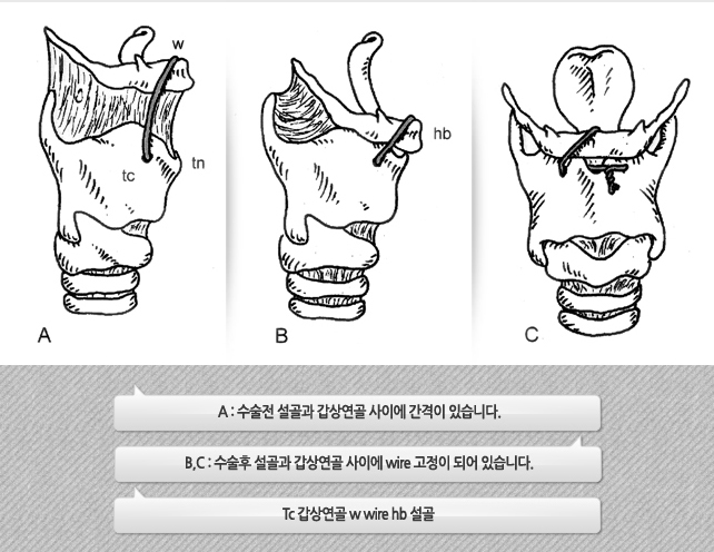 (집중) 코골이수술을 알아보자(3) 혀 뒷부위 / 설골고정술 : 네이버 블로그