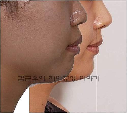 돌출입 교정 - 돌출입, 치아교정으로 예뻐지세요. : 네이버 블로그