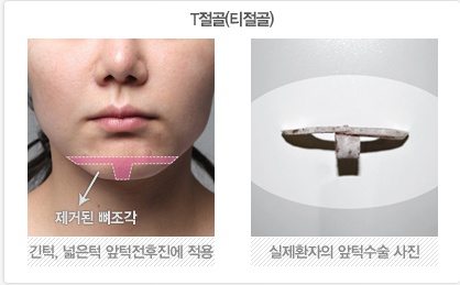 티절골(T절골)과 샌드위치절골(ㅡ자절골) 실제 뼈의 모습. : 네이버 블로그
