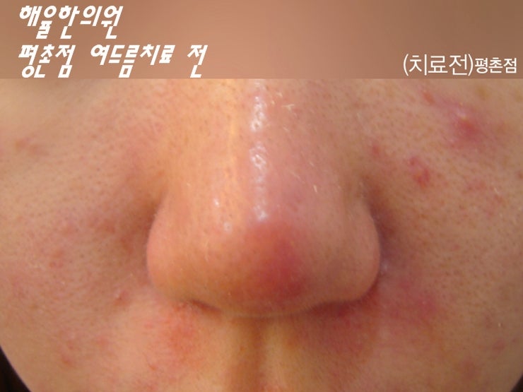 코 여드름 빨리 없애는법, 가라앉히는법 : 네이버 블로그