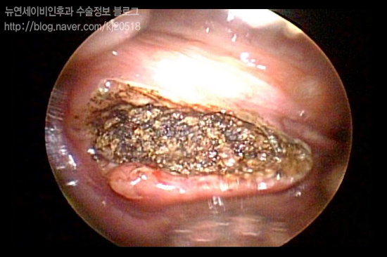 편도결석수술후냄새가나요 : 네이버 블로그