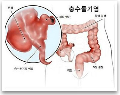 [간호이야기]충수돌기염(Appendictis) : 네이버 블로그