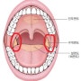 편도선염
