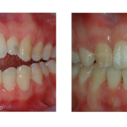 <안산 바른이박상민치과>위아래 치아가 안닿아요