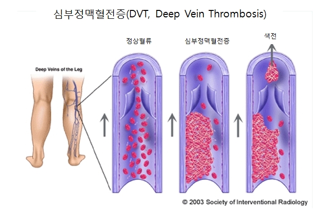 [부산하지정맥류]부산흉부외과 - 심부정맥혈전증(DVT,Deep Vein Thrombosis) : 네이버 블로그