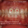 Anterior tooth replacement with natural dental zirconia crowns