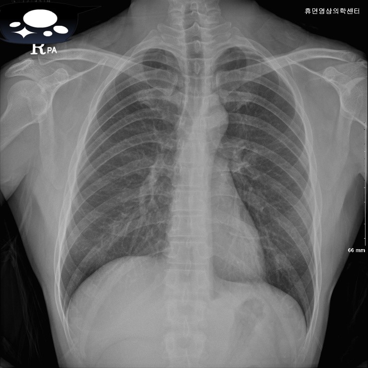 저선량 폐 CT 로 폐암 조기진단 : 네이버 블로그