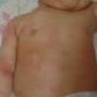 신생아(영유아)아토피성 피부염/강북에스엠산후도우미