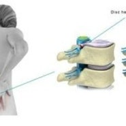 매선과 봉독을 이용한 디스크 질환 치료
