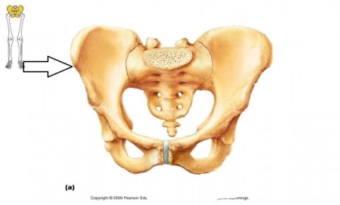 Anterior Superior Iliac Spine(ASIS) avulsion fracture/전상장골극 골절/골반뼈 골절 ...