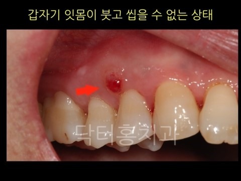 잇몸에 뭐가 낫어요. 잇몸 고름주머니... : 네이버 블로그 잇몸에 뭐가 낫어요. 잇몸 고름주머니... : 네이버 블로그