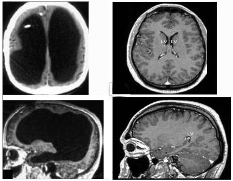 (미스테리)뇌가 없는 사람(Brainless Man) : 네이버 블로그