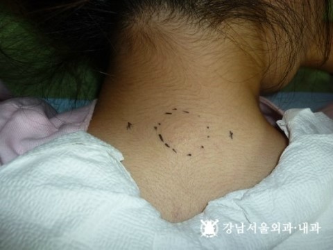 표피낭종 제거 수술 시기는 언제? : 네이버 블로그