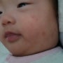 생후4개월 수족구,수두,헤르페스,대상포진 (2)