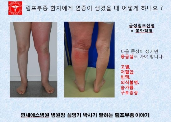 [림프부종] 림프부종 환자에게 염증이 생겼을 때 어떻게 하나요 ? : 네이버 블로그