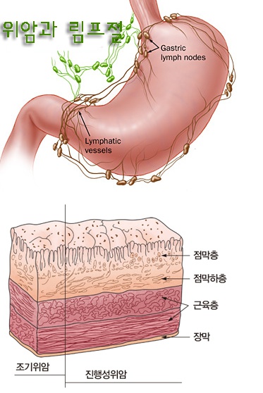 위암 초기증상 위선암 소화불량 ,구토,빈혈 : 네이버 블로그