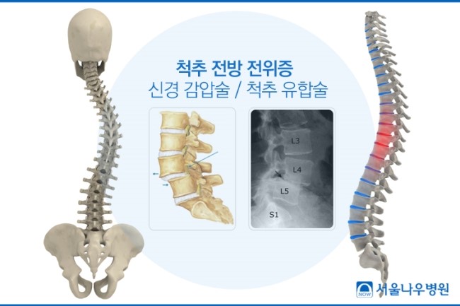 만성요추 불안정증, 허리뼈가 흔들려 생기는 요통증상 : 네이버 블로그