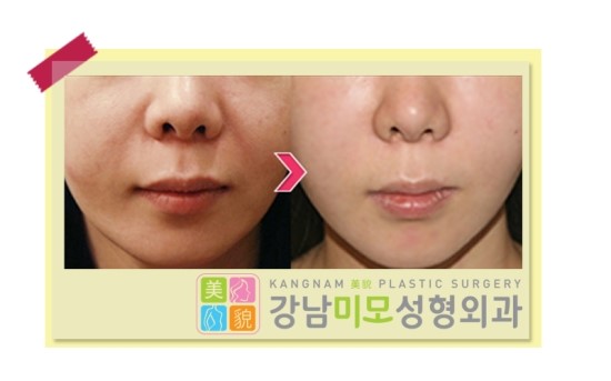 실리프팅가격 알아보려면 강남미모성형외과 : 네이버 블로그