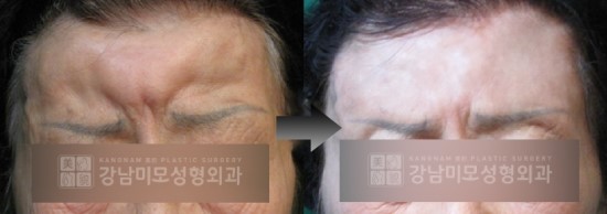 강남미모성형외과 이물질제거ː불법성형 필러제거 : 네이버 블로그