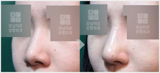 낮은코 스트레스 날려버리자!! 강남미모성형외과의 낮은코수술♥ : 네이버 블로그