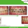 더블유와이치과 어린이 치아교정 전후사진 (WY치과)