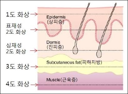 [화상센터] 1도, 2도, 3도 화상이란? 심재성 2도 화상은? : 네이버 블로그