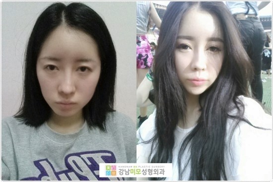지방이식잘하는곳에서 얼굴자가지방이식 받았다!! : 네이버 블로그