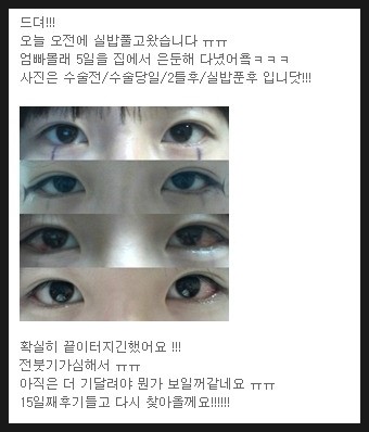 아이유같은 눈됨 ㅋㅋ 뒤트임밑트임 후기 : 네이버 블로그